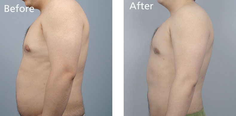 BodyFX_before-after-004