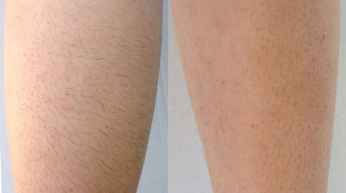 laser-hair-removal-before-and-after-6-sessions