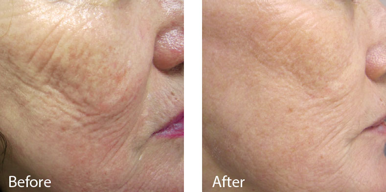 Anti aging skin care treatments