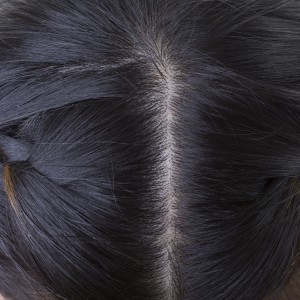 Scalp Psoriasis Treatment