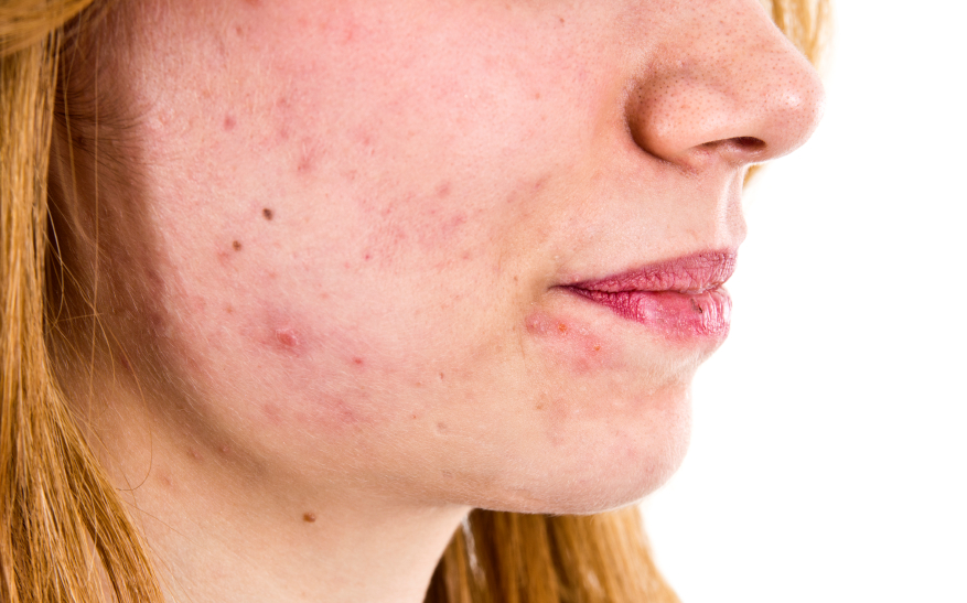 Acne skin care treatment