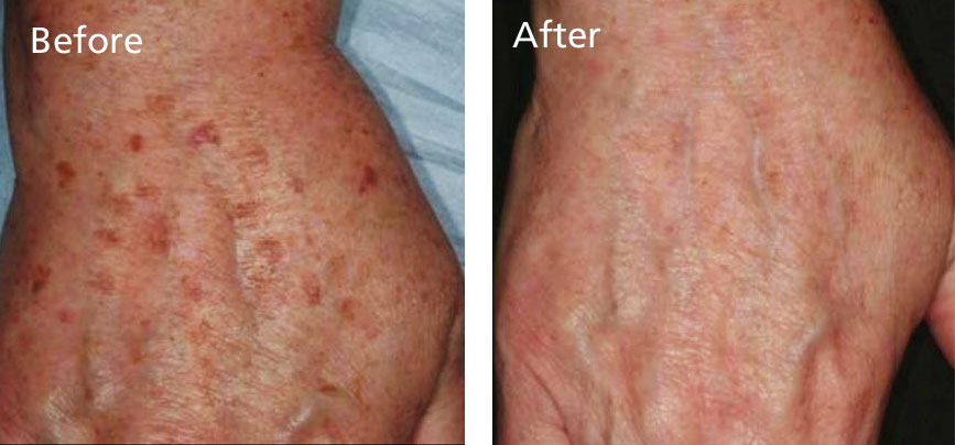 Restore your hands by clearing away brown age spots