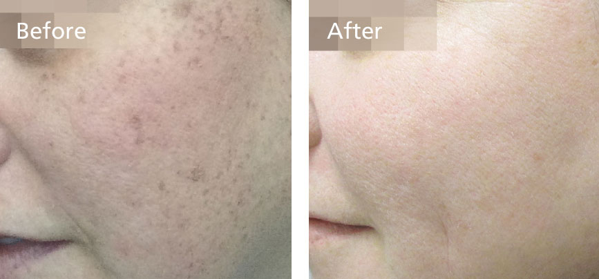 Resolve freckles, sun spots and age spots in 1 treatment