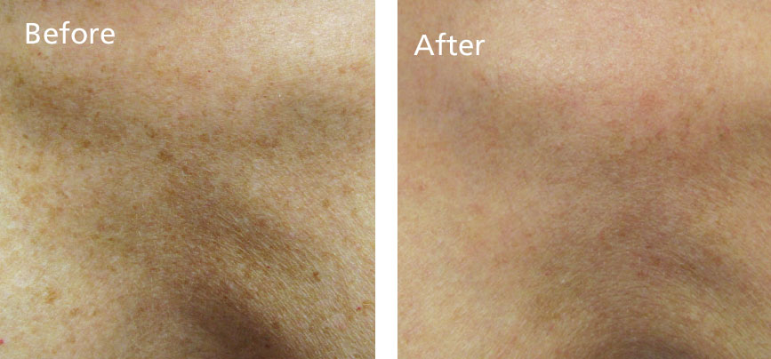 Improvements in brown age spots on the decolletage in 1 treatment