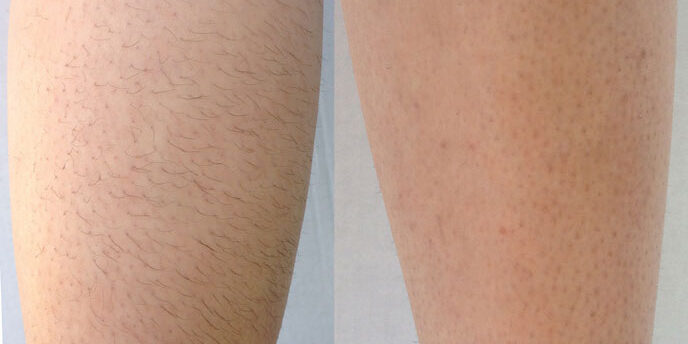 Laser hair removal