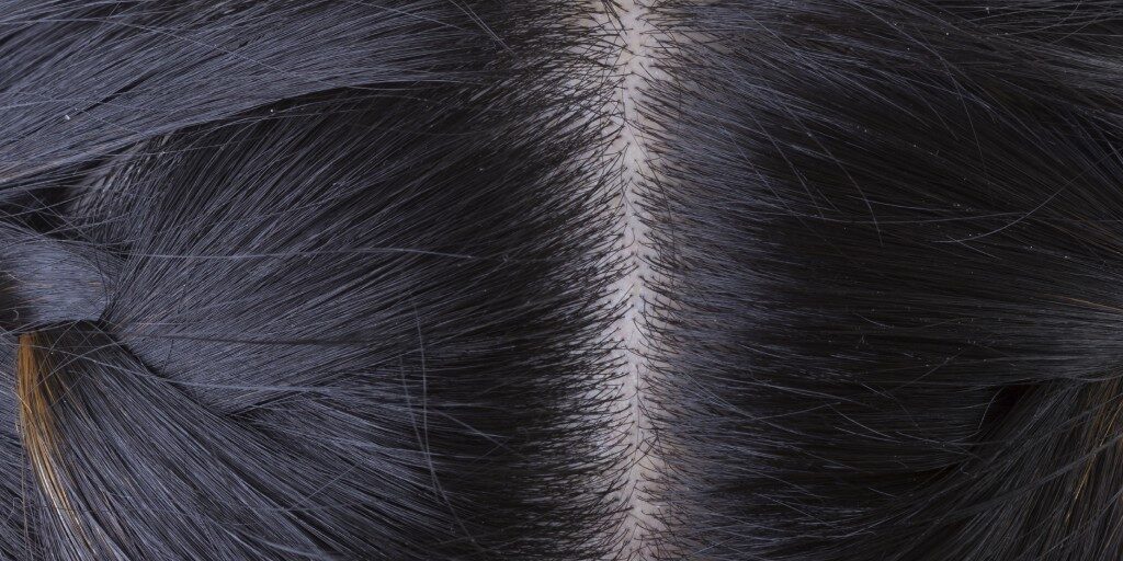 Scalp Psoriasis Treatment